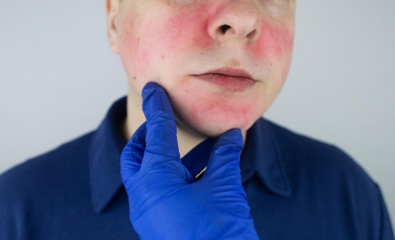 Soothing Rosacea: Expert Care at The Facial Bar